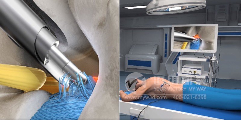 醫學(xué)三維動(dòng)畫(huà)制作效果展示-上海三維動(dòng)畫(huà)制作(圖2) 醫學(xué)三維動(dòng)畫(huà)制作效果展示-上海三維動(dòng)畫(huà)制作(圖2)